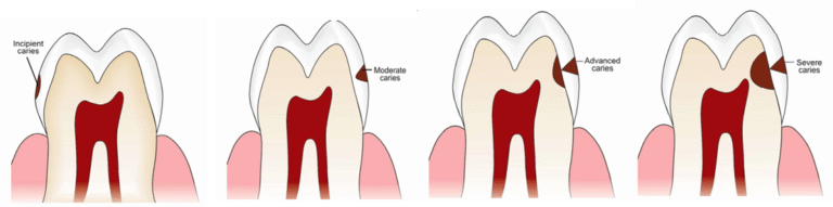 Classification of Dental Caries