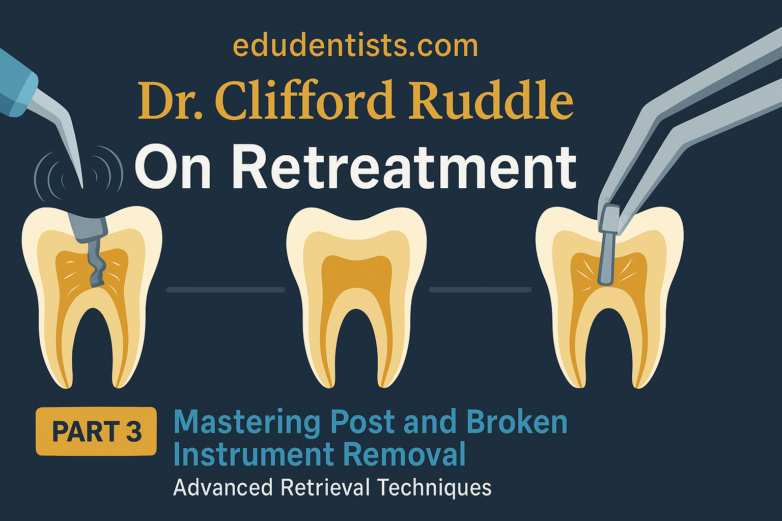 Mastering Post and Broken Instrument Removal