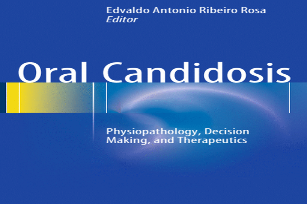 Oral Candidosis Physiopathology, Decision Making & Therapeutics – Free PDF